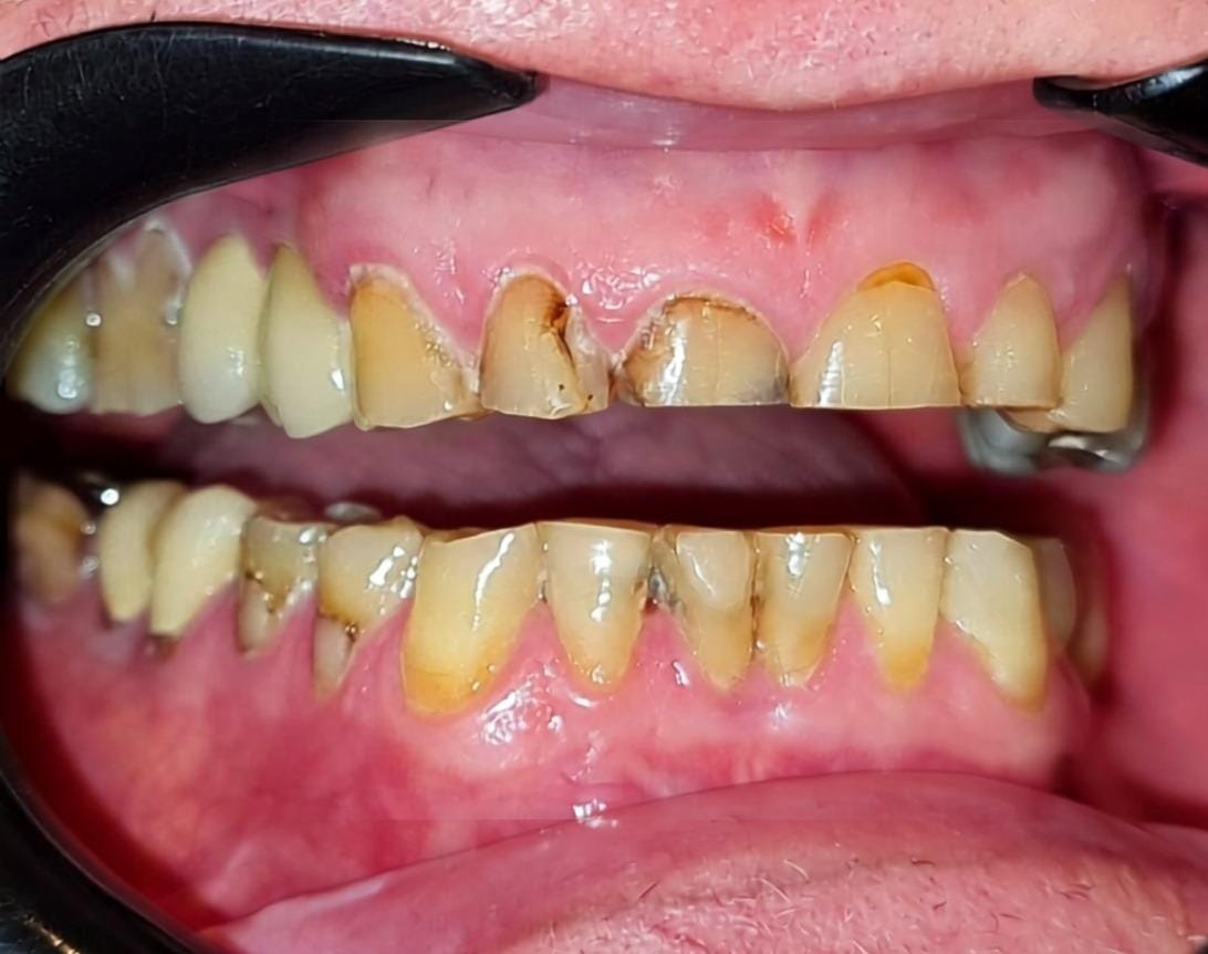 Situação inicial do paciente com desgaste dentário associado ao bruxismo