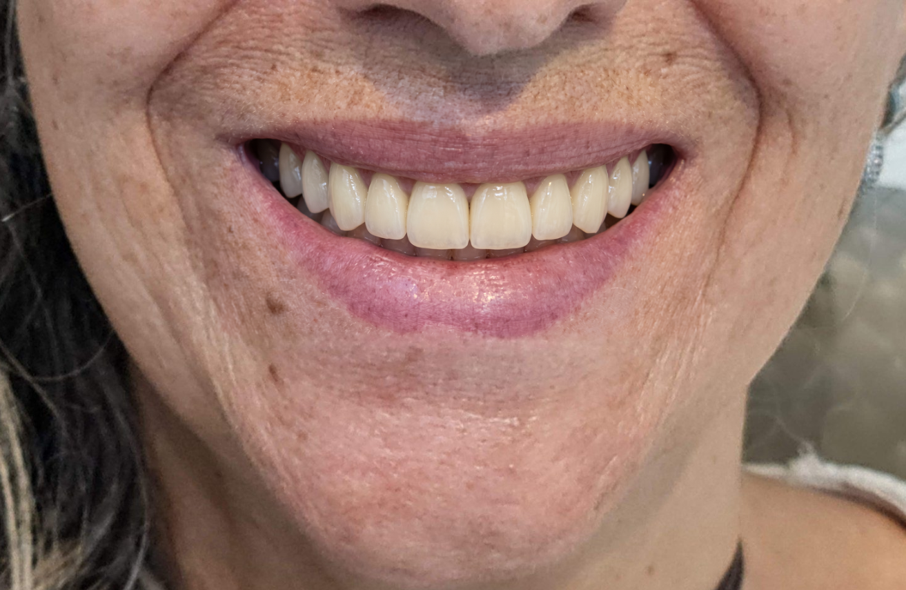 Simulação estética digital do sorriso planejado